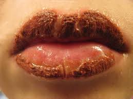 последствия перманентного макияжа губ