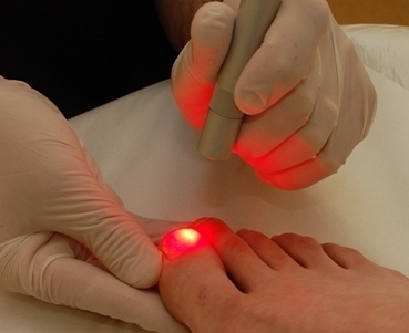 лечение лазером грибка ногтей